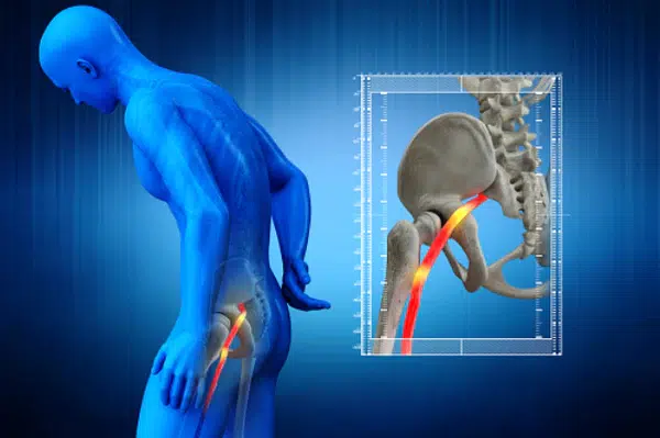 How can a person manage sciatic nerve pain at night?